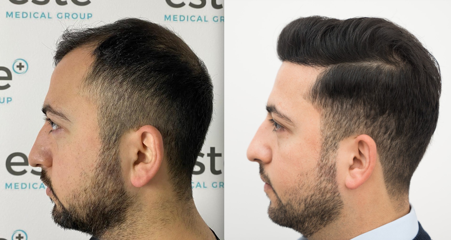 1 Year After Hair Transplant, Birmingham Man Shares New Hair Growth